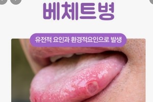 [이런 병, 저런 병] ⑩구강 궤양 자주 생기면 ‘베체트병’일까?