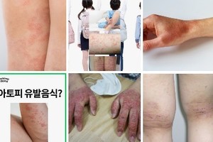 추울 때 심해지는 난치병 ‘아토피피부염’