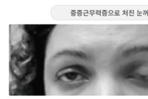 [이런 병, 저런 병] ⑯눈꺼풀부터 처지는 중증근무력증